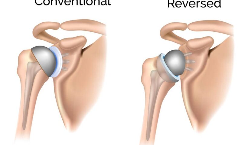 A STEP-BY-STEP PROCESS OF A TOTAL SHOULDER REPLACEMENT SURGERY